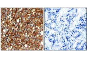 Immunohistochemical analysis of paraffin-embedded human lung carcinoma tissue, using CD340 / ERBB2 / HER2 Antibody (pTyr1248) (ErbB2/Her2 anticorps  (pTyr1248))
