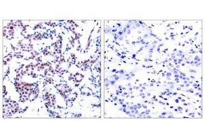 Immunohistochemical analysis of paraffin-embedded human breast carcinoma tissue using JunB(Phospho-Ser259) Antibody(left) or the same antibody preincubated with blocking peptide(right). (JunB anticorps  (pSer259))