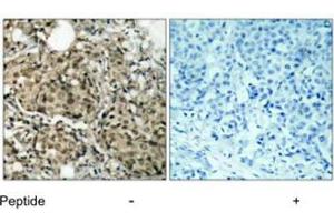 Imunohistochemical analysis of paraffin-embedded human breast carcinoma tissue using G3BP1 polyclonal antibody . (G3BP1 anticorps)