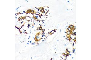 Immunohistochemistry of paraffin-embedded Human lung cancer using  Rabbit pAb (ABIN6131176, ABIN6136646, ABIN6136647 and ABIN6222857) at dilution of 1:100 (40x lens). (AGR2 anticorps  (AA 21-175))