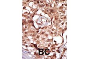 Formalin-fixed and paraffin-embedded human cancer tissue reacted with RIPK2 polyclonal antibody  , which was peroxidase-conjugated to the secondary antibody, followed by AEC staining. (RIPK2 anticorps  (C-Term))