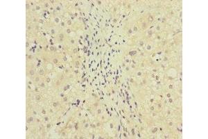 Immunohistochemistry of paraffin-embedded human liver cancer using ABIN7159631 at dilution of 1:100