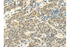 The image on the left is immunohistochemistry of paraffin-embedded Human liver cancer tissue using ABIN7130215(MED16 Antibody) at dilution 1/20, on the right is treated with fusion protein. (MED16 anticorps)
