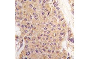 IHC analysis of FFPE human breast carcinoma tissue stained with TGF Beta 2 antibody (TGFB2 anticorps  (AA 277-306))