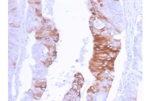 Formalin-fixed, paraffin-embedded human Colon Carcinoma stained with Cytokeratin 20 Recombinant Rabbit Monoclonal Antibody (KRT20/3129R). (Recombinant KRT20 anticorps  (AA 196-323))