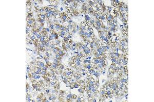 Immunohistochemistry of paraffin-embedded human liver cancer using FUC Rabbit pAb (ABIN6127916, ABIN6140809, ABIN6140811 and ABIN6215812) at dilution of 1:200 (40x lens). (FUCA2 anticorps  (AA 118-467))