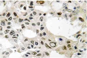 Immunohistochemistry (IHC) analyzes of eIF3D antibody staining in Paraffin-Embedded Human breast carcinoma tissue. (EIF3D anticorps)