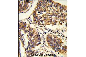 Formalin-fixed and paraffin-embedded human lung carcinoma reacted with PABPC1 Antibody , which was peroxidase-conjugated to the secondary antibody, followed by DAB staining.
