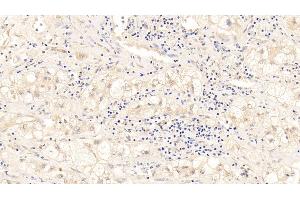 Detection of TDP43 in Human Liver cancer Tissue using Polyclonal Antibody to Tar DNA Binding Protein 43 kDa (TDP43)