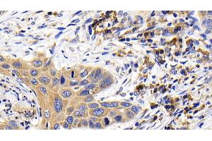 Detection of BCL2L11 in Human Lung cancer Tissue using Polyclonal Antibody to Bcl2 Like Protein 11 (BCL2L11)