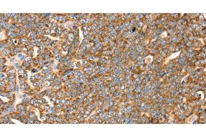 Immunohistochemistry of paraffin-embedded Human cervical cancer tissue using SLC8A3 Polyclonal Antibody at dilution 1:35 (SLC8A3 anticorps)