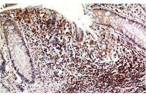 Immunohistochemistry of paraffin-embedded Human colon carcinoma tissue using Epsilon Tubulin Monoclonal Antibody at dilution of 1:200.