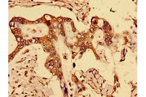 Immunohistochemistry of paraffin-embedded human breast cancer using ABIN7150562 at dilution of 1:100