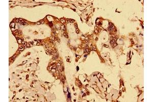 Immunohistochemistry of paraffin-embedded human breast cancer using ABIN7150562 at dilution of 1:100 (DOK1 anticorps  (AA 1-481))