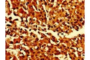 Immunohistochemistry of paraffin-embedded human breast cancer using ABIN7146907 at dilution of 1:100 (CARD14 anticorps  (AA 249-523))
