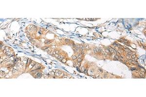 Immunohistochemistry of paraffin-embedded Human colorectal cancer tissue using B4GAT1 Polyclonal Antibody at dilution of 1:110(x200)