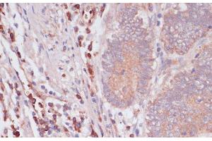 Immunohistochemistry of paraffin-embedded Human colon carcinoma using IFNAR2 Polyclonal Antibody at dilution of 1:100 (40x lens). (IFNAR2 anticorps)