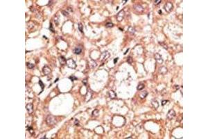 IHC analysis of FFPE human hepatocarcinoma stained with the LSD1 antibody