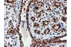Immunohistochemical staining of paraffin-embedded Human breast tissue using anti-PADI4 mouse monoclonal antibody. (PAD4 anticorps)