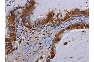 The image on the left is immunohistochemistry of paraffin-embedded Human esophagus cancer tissue using ABIN7130211(MECP2 Antibody) at dilution 1/60, on the right is treated with fusion protein. (MECP2 anticorps)