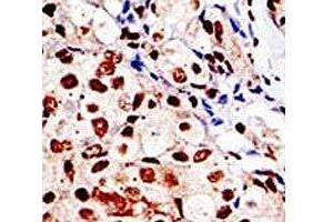 IHC analysis of FFPE human breast carcinoma tissue stained with the SUMO antibody (SUMO1 anticorps  (AA 52-79))