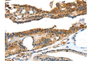 The image on the left is immunohistochemistry of paraffin-embedded Human thyroid cancer tissue using ABIN7131111(SNAI3 Antibody) at dilution 1/20, on the right is treated with fusion protein. (SNAI3 anticorps)