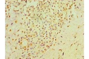 Immunohistochemistry of paraffin-embedded human breast cancer using ABIN7162034 at dilution of 1:100 (NXNL1 anticorps  (AA 1-200))
