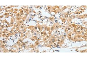 Immunohistochemistry of paraffin-embedded Human liver cancer tissue using BPIFB2 Polyclonal Antibody at dilution 1:45