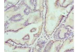 Immunohistochemistry of paraffin-embedded human prostate cancer using ABIN7157212 at dilution of 1:100
