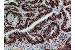 Immunohistochemistry (IHC) analysis of paraffin-embedded Human Colont-cancer, antibody was diluted at 1:200. (GLB1 anticorps)