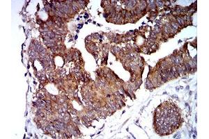 Immunohistochemical analysis of paraffin-embedded rectum cancer tissues using TRIM25 mouse mAb with DAB staining.