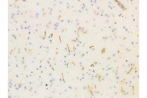 ABIN6258344 and ABIN6275543 at 1/100 staining human glioblastoma by IHC-P.