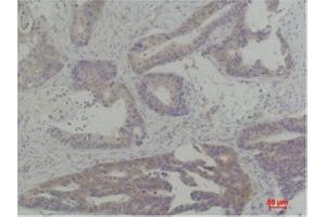Immunohistochemistry (IHC) analysis of paraffin-embedded Human Breast Carcinoma using TBP Rabbit Polyclonal Antibody diluted at 1:200. (TBP anticorps)