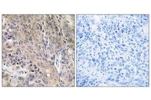 Immunohistochemistry analysis of paraffin-embedded human lung carcinoma tissue using LAMP3 antibody. (LAMP3 anticorps  (Internal Region))