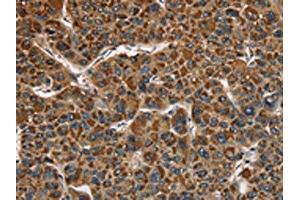 The image on the left is immunohistochemistry of paraffin-embedded Human liver cancer tissue using ABIN7128790(CAT Antibody) at dilution 1/40, on the right is treated with fusion protein. (Catalase anticorps)