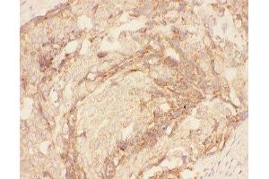 IHC-P: Eotaxin 3 antibody testing of human breast cancer tissue