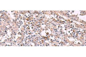 Immunohistochemistry of paraffin-embedded Human tonsil tissue using ADH1B Polyclonal Antibody at dilution of 1:55(x200) (ADH1B anticorps)