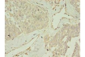 Immunohistochemistry of paraffin-embedded human endometrial cancer using ABIN7148088 at dilution of 1:100 (CCDC14 anticorps  (AA 159-440))