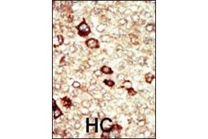 Formalin-fixed and paraffin-embedded human cancer tissue reacted with the primary antibody, which was peroxidase-conjugated to the secondary antibody, followed by AEC staining.