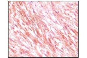 Immunohistochemical analysis of paraffin-embedded maligant mesenchymoma tissues, showing cytoplasmic localization using C-kit antibody with DAB staining. (KIT anticorps)