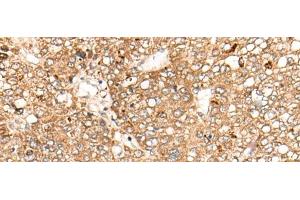 Immunohistochemistry of paraffin-embedded Human liver cancer tissue using C1S Polyclonal Antibody at dilution of 1:55(x200) (C1S anticorps)