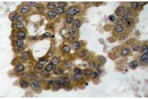 Immunohistochemistry (IHC) analyzes of p-Akt2 antibody in paraffin-embedded human lung carcinoma tissue. (AKT2 anticorps  (pSer474))