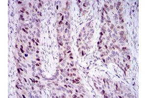 Immunohistochemical analysis of paraffin-embedded cervical cancer tissues using HDAC10 mouse mAb with DAB staining. (HDAC10 anticorps  (AA 18-219))