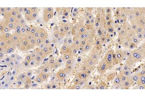 Detection of IL13Ra2 in Human Liver Tissue using Polyclonal Antibody to Interleukin 13 Receptor Alpha 2 (IL13Ra2)