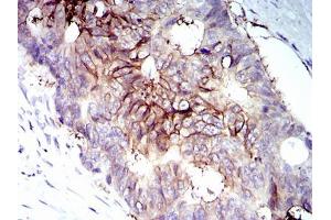 Immunohistochemical analysis of paraffin-embedded rectum cancer tissues using IGF1R-Beta mouse mAb with DAB staining. (IGF1R-beta (AA 1101-1367) anticorps)