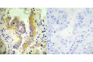 Immunohistochemical analysis of paraffin- embedded human lung carcinoma tissue using Tsc2 (Ab-1462) antibody (E022050). (Tuberin anticorps)