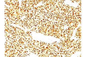 Formalin-fixed, paraffin-embedded human Rhabdomyosarcoma stained with MyoD1 Mouse Monoclonal Antibody (SPM427).
