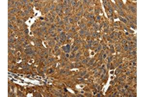 The image on the left is immunohistochemistry of paraffin-embedded Human ovarian cancer tissue using ABIN7129340(EIF2AK3 Antibody) at dilution 1/40, on the right is treated with fusion protein.