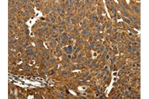 The image on the left is immunohistochemistry of paraffin-embedded Human ovarian cancer tissue using ABIN7129340(EIF2AK3 Antibody) at dilution 1/40, on the right is treated with fusion protein. (COQ3 anticorps)