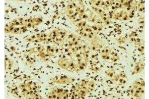 ABIN6268996 at 1/100 staining Human breast cancer tissue by IHC-P. (PRKACA anticorps  (Internal Region))